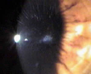 Ceratocone