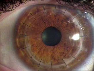 Ceratocone
