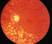 Retinopatia