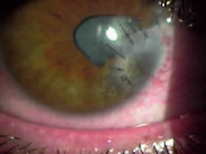 Trauma ocular
