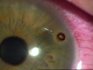 Trauma ocular