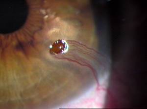 Trauma ocular